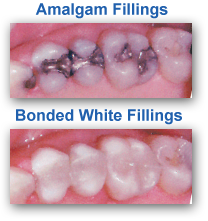 White Dental Fillings Fairway KS